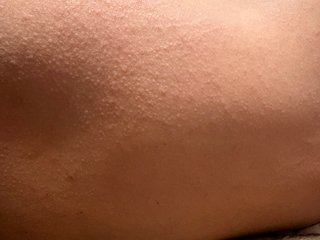 子供の背中痒い痒いと言ってます
