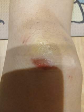 先週金曜日に自転車から落ちて転倒しました…　写真閲覧注意