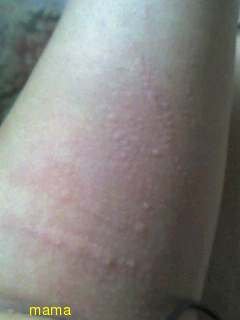 今、急に左腕に湿疹が…(写真あり)