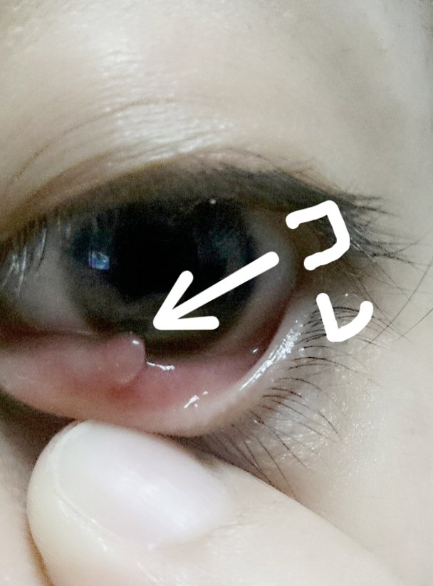まぶた の 裏 に でき もの | 瞼裏 できもの 違和感 | 偽膜性結膜炎(よくある目の病気 19) – EALP