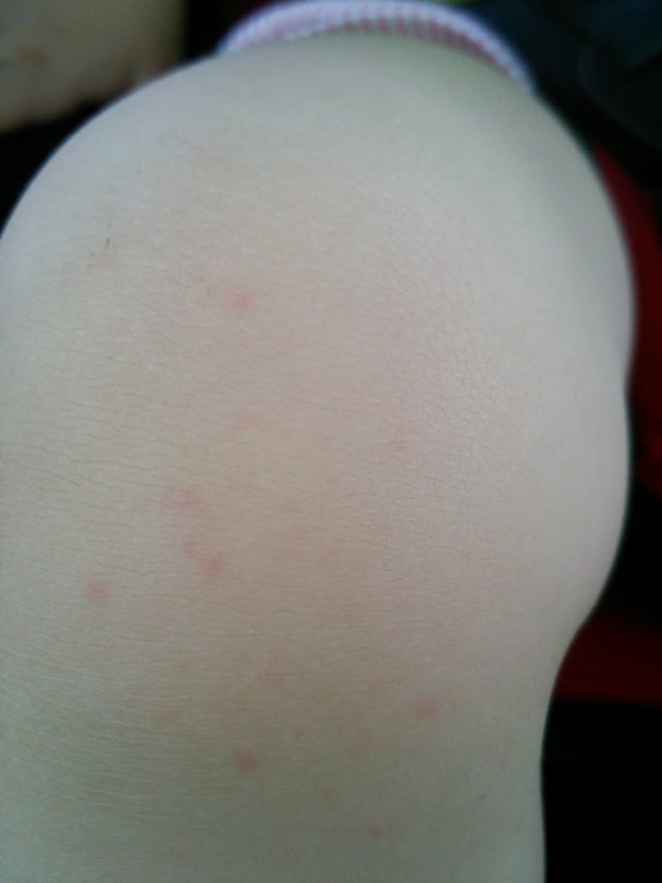 1歳9ヶ月。全身に湿疹。