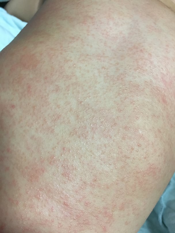 1歳9ヶ月。全身に湿疹。