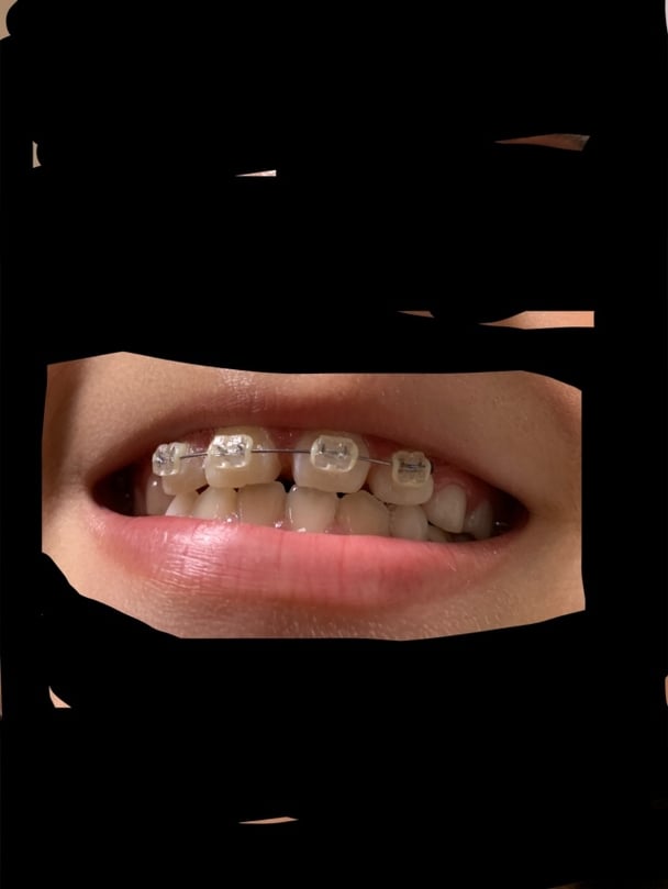 子供の歯の矯正70万くらいすると言われたら躊躇する？