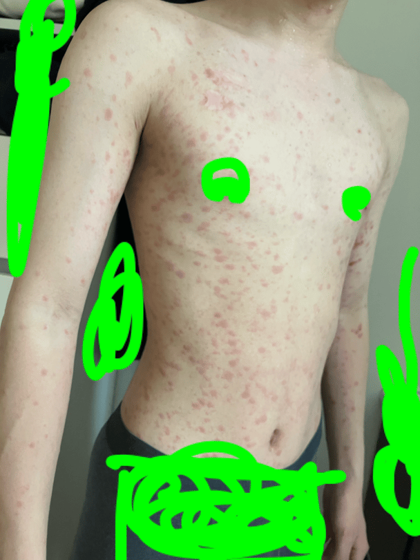グロ画注意！１４歳の子供の湿疹